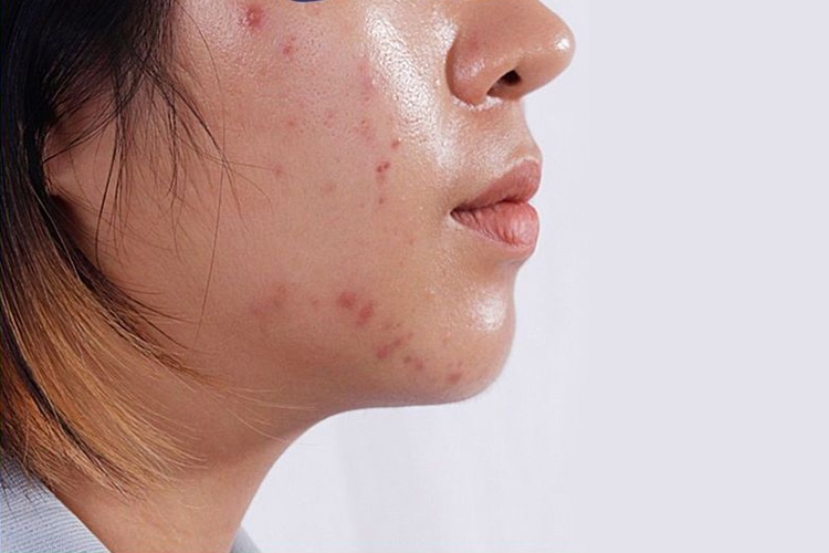 ویژگی های ضد آفتاب پوست چرب